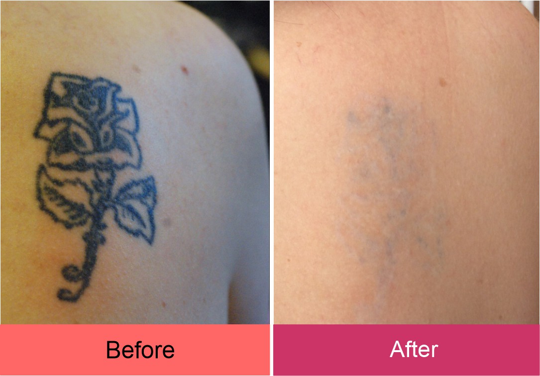 Best Skin Doctor For Laser Tatto Removal In Hyderabad
